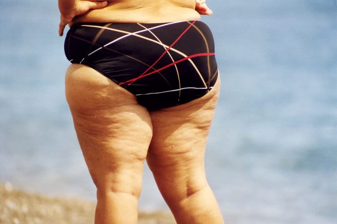 What Causes Cellulite Million Dollar Baby Fitness