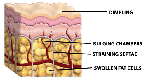 Cellulite Structure